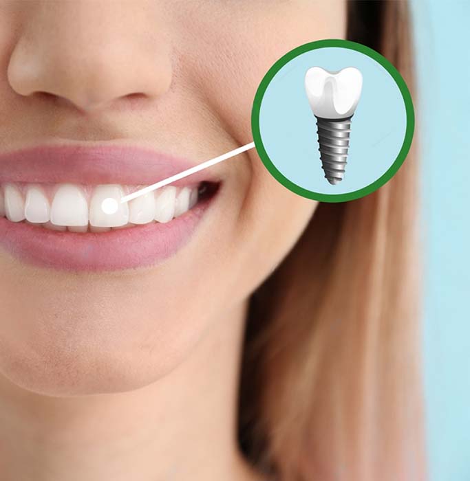 implante dental clinicalvor
