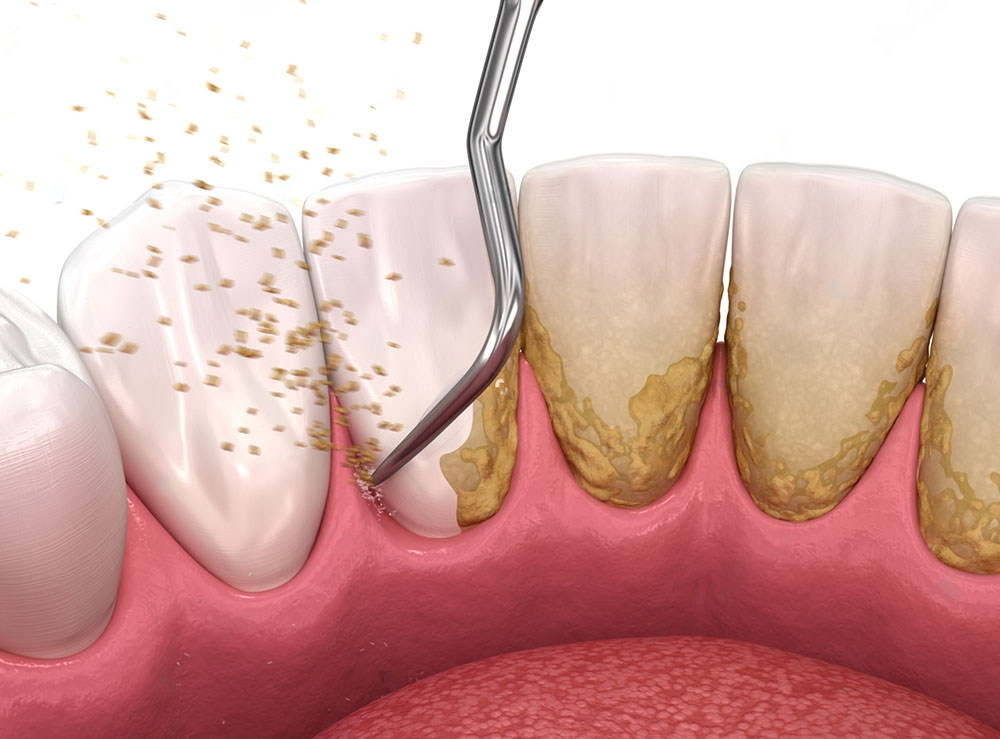 como retirar o tártaro dos seus dentes