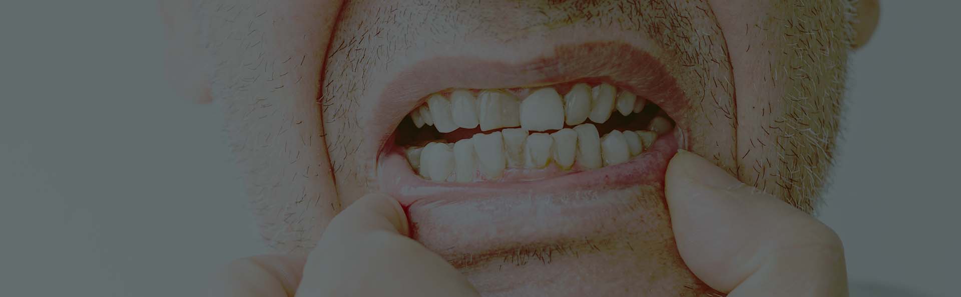 como retirar o tártaro dos seus dentes2