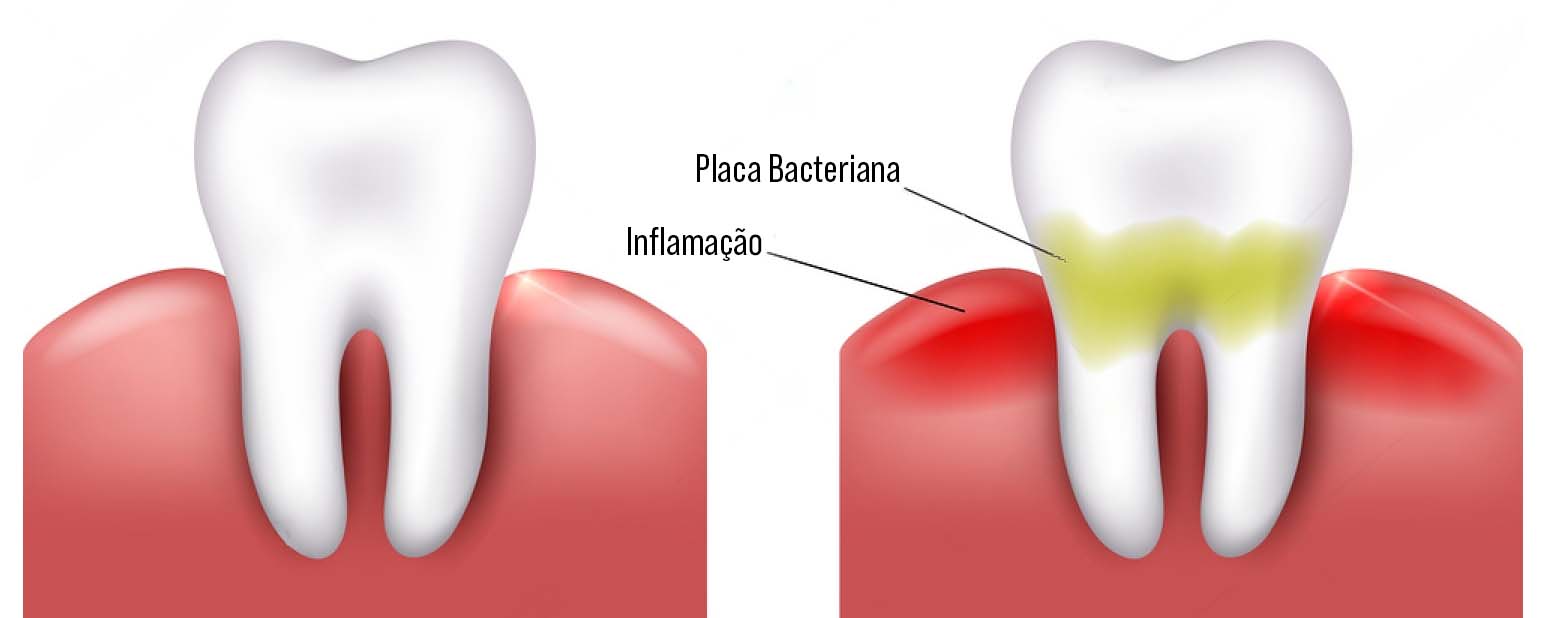 placa bacteriana