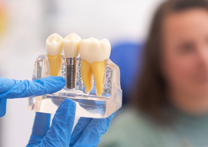 implantes dentários como funcionam?
