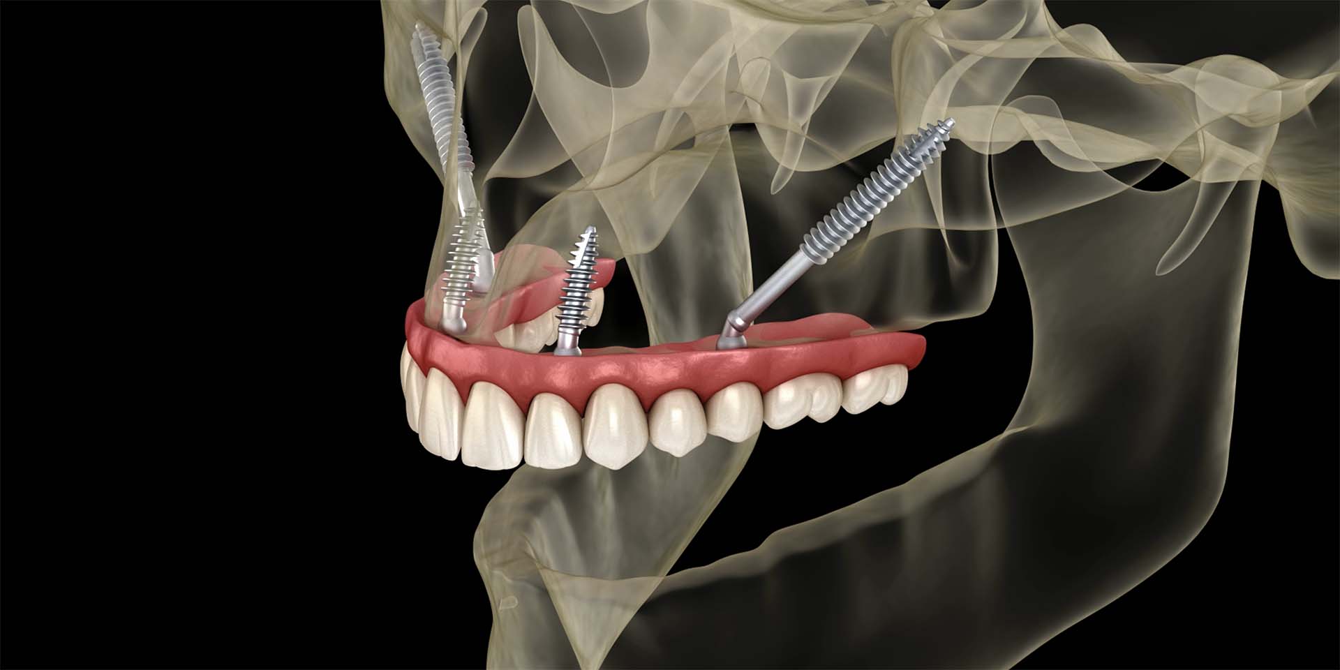 avanços em implantes zigomáticos