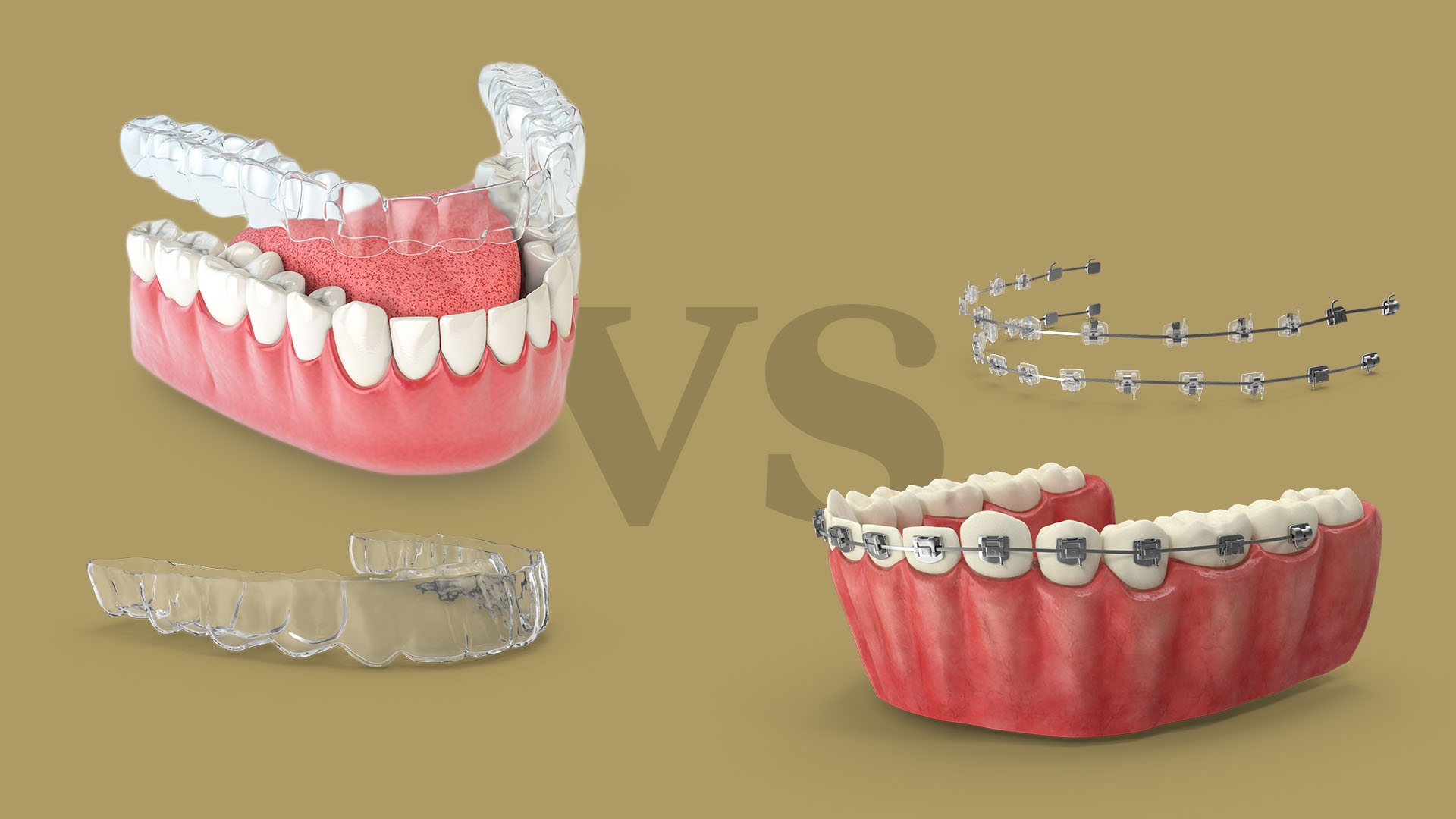 aparelho invisível ou tradicional vantagens e diferenças