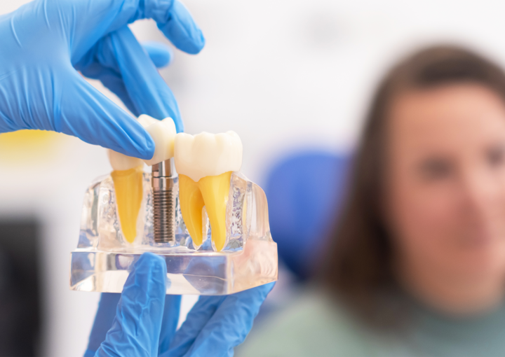 longevidade dos implantes dentários