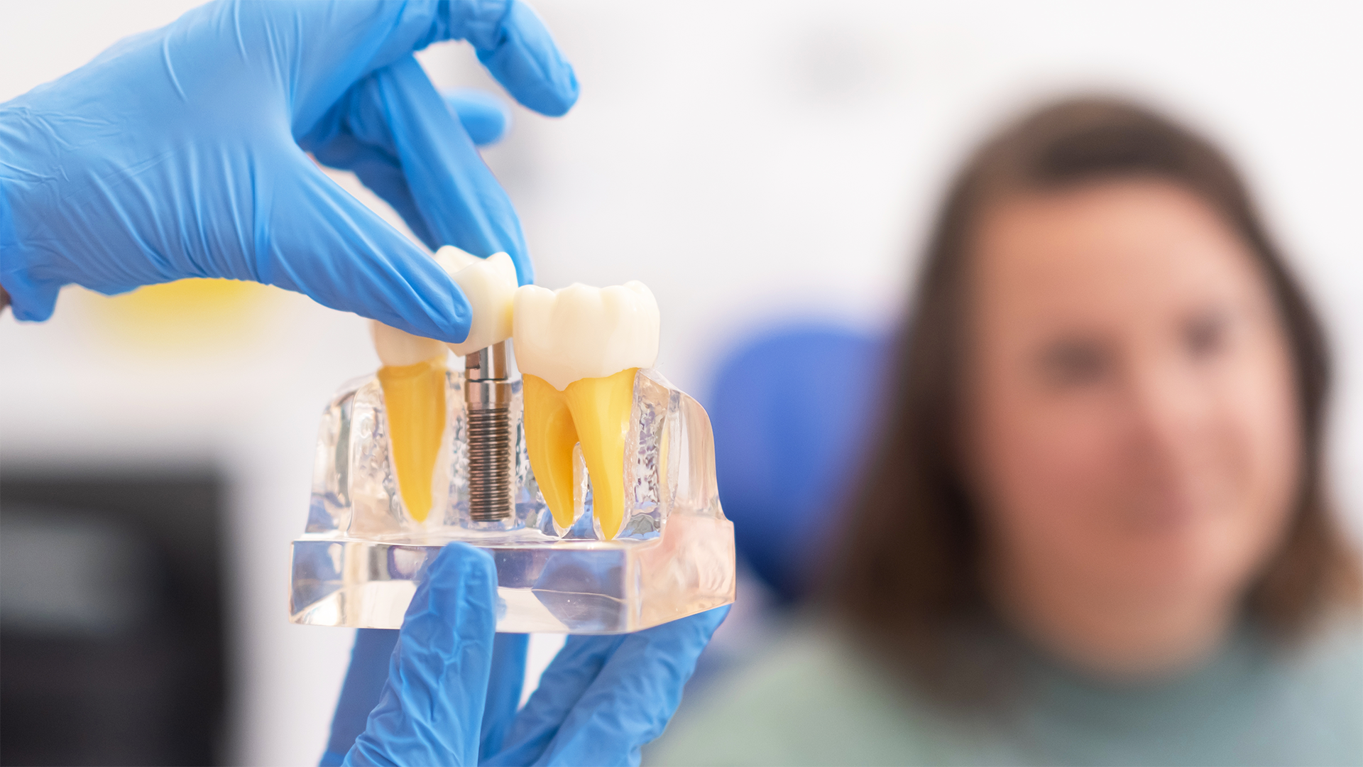 longevidade dos implantes dentários