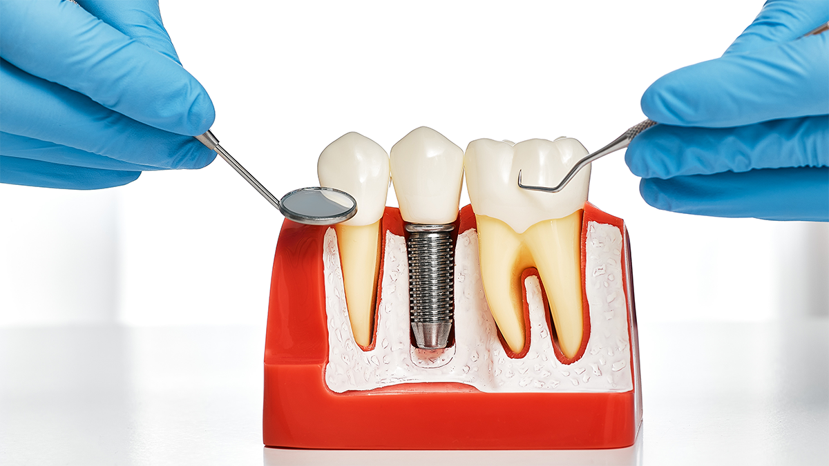 longevidade dos implantes dentários1