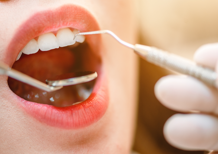 periodontite controlada ainda posso colocar implantes?
