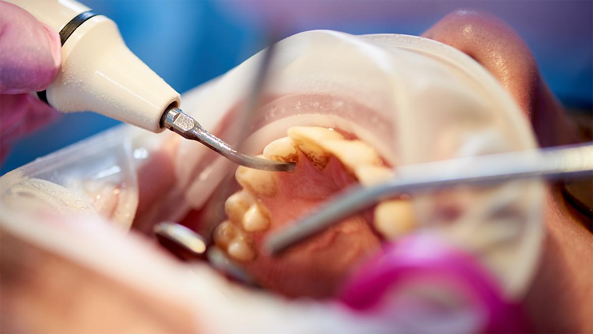 periodontite controlada ainda posso colocar implantes?1
