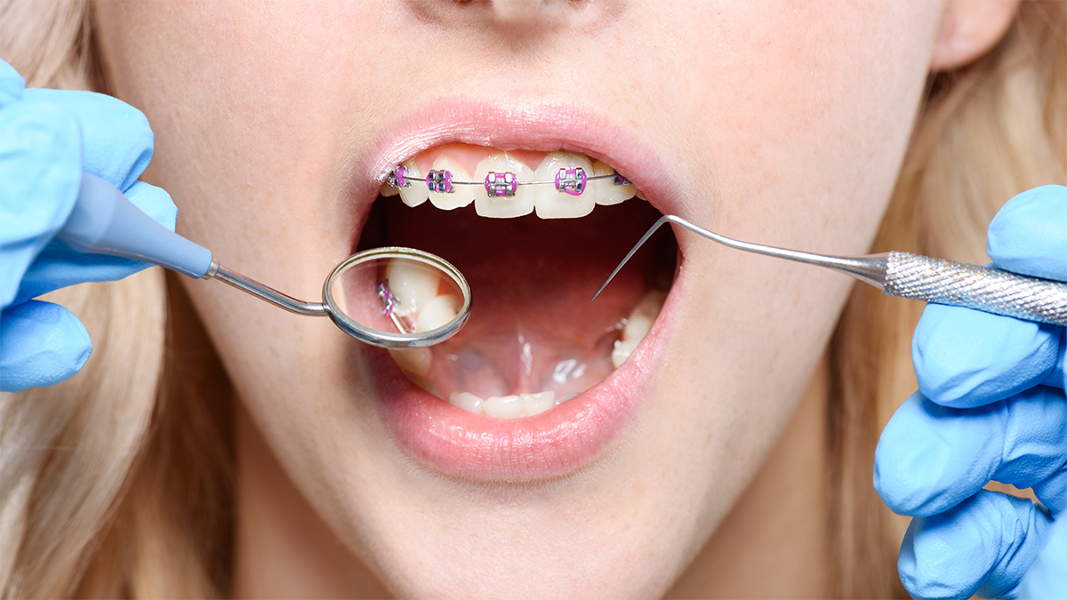 ortodontia e implantes qual deve ser o primeiro passo?